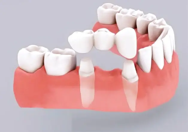 Trồng Răng Giả: Các Phương Pháp Phổ Biến, Ưu Nhược Điểm & Chi Phí Cập Nhật
